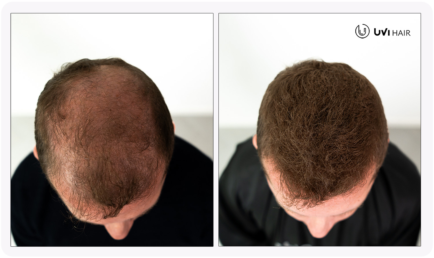 UVI Hair vlakna za kosu, AUBURN / Kestenjasta (velika 27,5 g, do 50 nanosa) - Slika 3